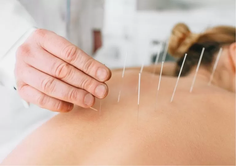 Dry Needling: A Modern Approach to Pain Relief